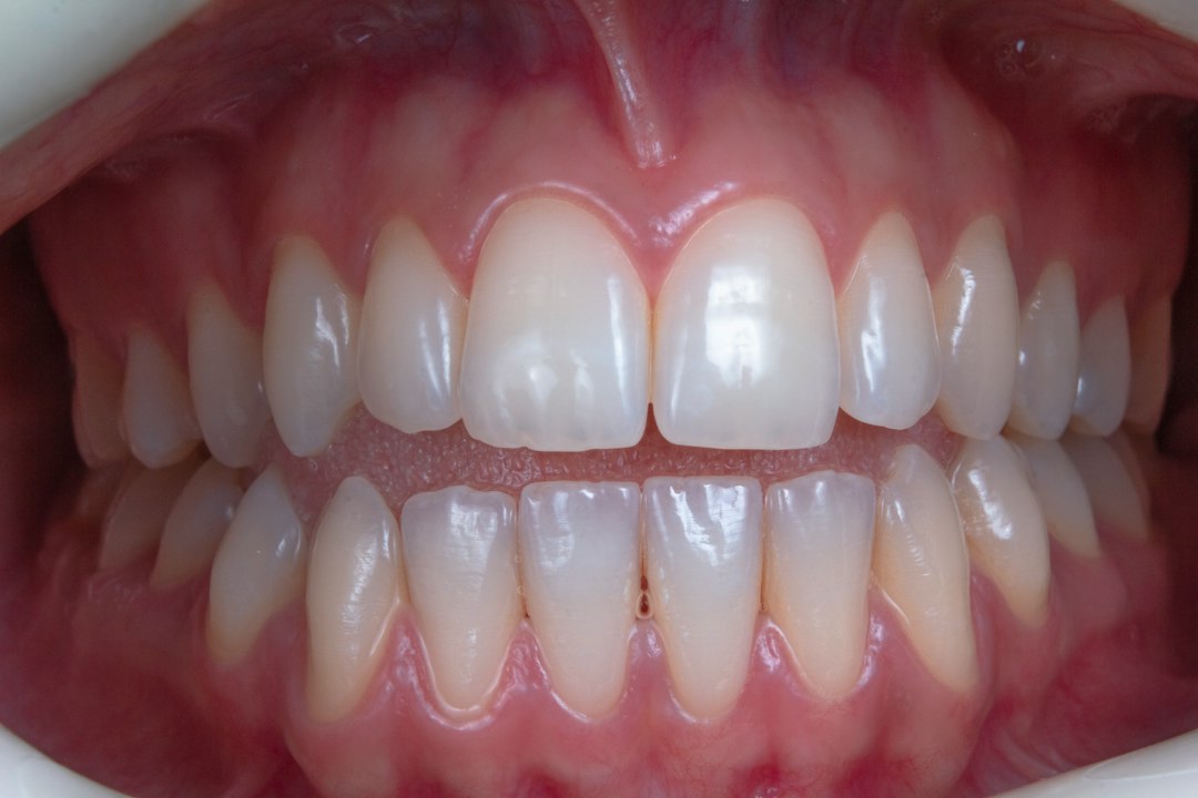 Gingivitis vs Periodontitis: How to Tell the Difference and What It Means